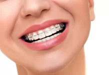 The Basics of Orthodontic Treatment
