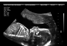 What to Expect During Your Private Ultrasound Appointment